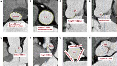 Relationship Between Leaflets and Root in Normal Aortic Valve Based on Computed Tomography Imaging: Implication for Aortic Valve Repair